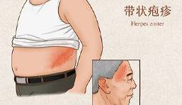 带状疱疹如何治疗后遗神经痛-三个简单的治疗方法2