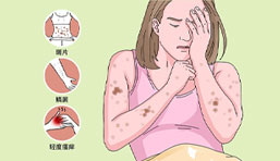 带状疱疹后神经痛,这几种食物尽量少吃,可能会加重病情2带状疱疹后神经痛,这几种食物尽量少吃,可能会加重病情2